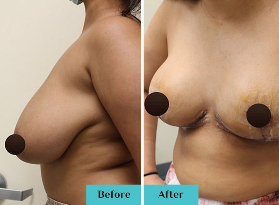 Breast Reduction Surgery-Newport Beach