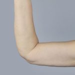 Brachioplasty Before & After Patient #899