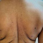 Bralift Before & After Patient #900