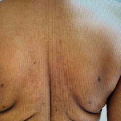 Bralift Before & After Patient #900