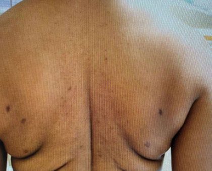 Bralift Before & After Patient #900