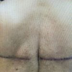 Bralift Before & After Patient #900