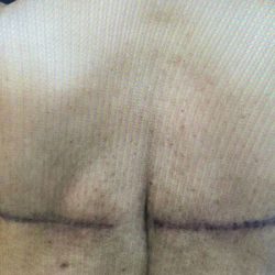 Bralift Before & After Patient #900