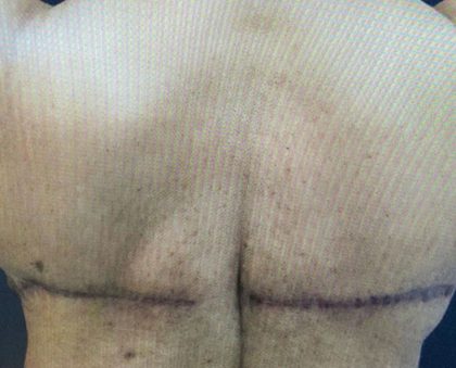 Bralift Before & After Patient #900