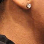 Chin Lipo Before & After Patient #901