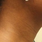 Chin Lipo Before & After Patient #901