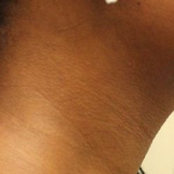 Chin Lipo Before & After Patient #901