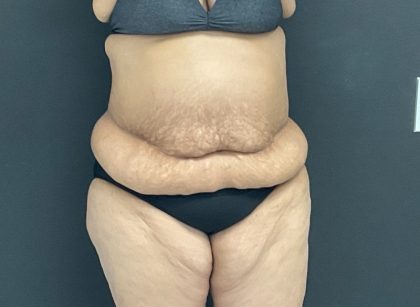 Mommy Makeover Before & After Patient #1006