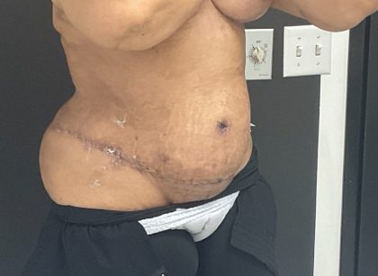 Mommy Makeover Before & After Patient #1006