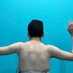 Brachioplasty Before & After Patient #994