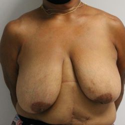Breast Reduction Before & After Patient #997
