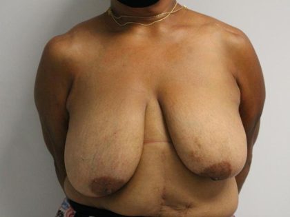 Breast Reduction Before & After Patient #997