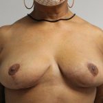Breast Reduction Before & After Patient #997