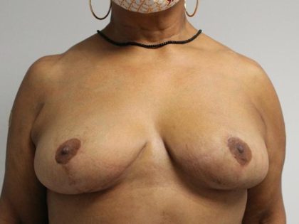 Breast Reduction Before & After Patient #997