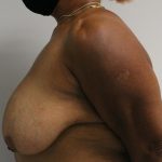 Breast Reduction Before & After Patient #997