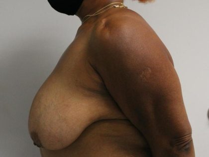 Breast Reduction Before & After Patient #997