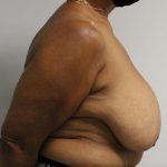 Breast Reduction Before & After Patient #997