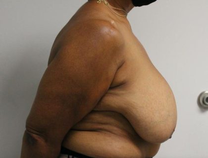 Breast Reduction Before & After Patient #997