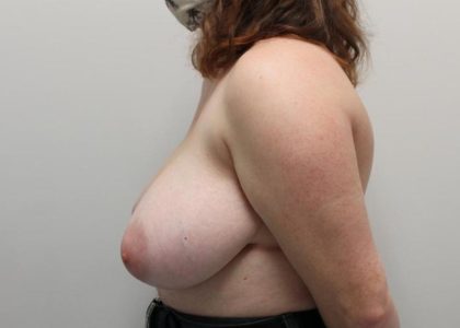 Breast Reduction and Lift Before & After Patient #999