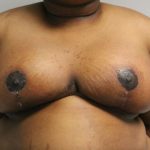 Breast Reduction and Lift Before & After Patient #1000