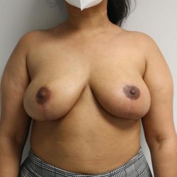 Natural Breast Lift Before & After Patient #1001