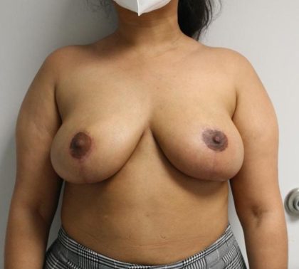 Natural Breast Lift Before & After Patient #1001