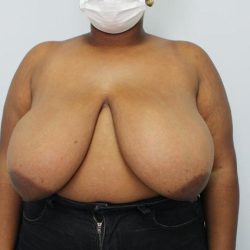Breast Reduction and Lift Before & After Patient #1002