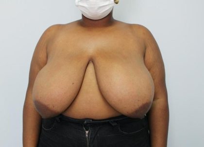 Breast Reduction and Lift Before & After Patient #1002
