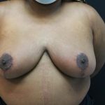 Breast Reduction and Lift Before & After Patient #1002