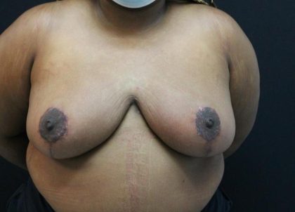 Breast Reduction and Lift Before & After Patient #1002