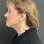 Neck Lift Before & After Patient #1003