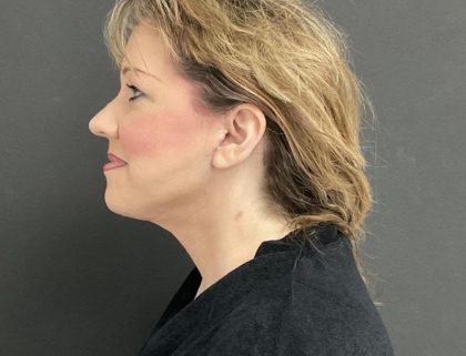 Neck Lift Before & After Patient #1003
