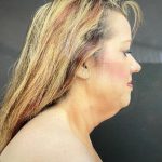 Neck Lift Before & After Patient #1003