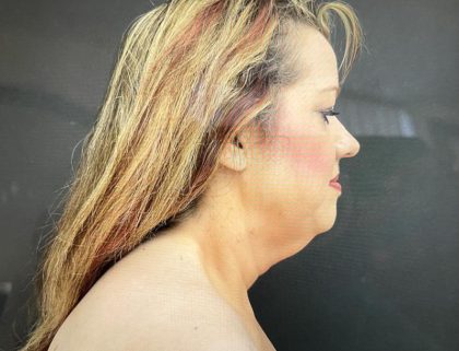 Neck Lift Before & After Patient #1003