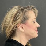Neck Lift Before & After Patient #1003