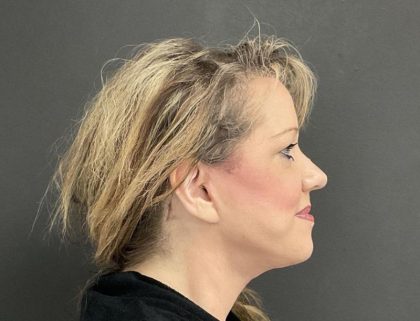 Neck Lift Before & After Patient #1003