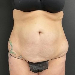 Abdominoplasty Before & After Patient #1005