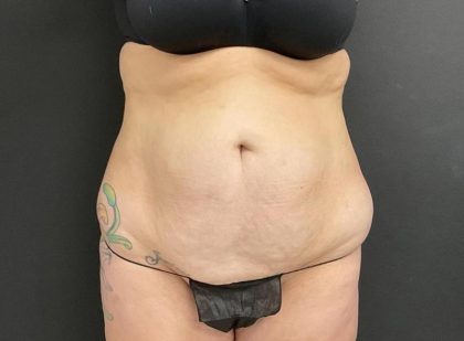 Abdominoplasty Before & After Patient #1005