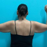 Brachioplasty Before & After Patient #1046