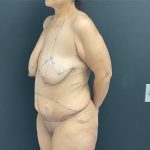 Abdominoplasty Before & After Patient #1047