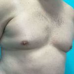 Gynecomastia Before & After Patient #1056
