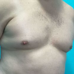 Gynecomastia Before & After Patient #1056
