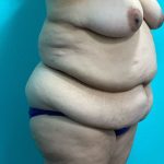 Mommy Makeover Before & After Patient #1058