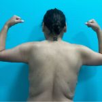 Brachioplasty Before & After Patient #1046