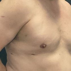 Gynecomastia Before & After Patient #1056