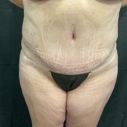 Abdominoplasty Before & After Patient #1057