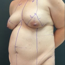 Abdominoplasty Before & After Patient #1043