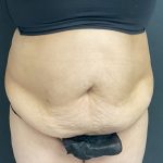Abdominoplasty Before & After Patient #1070