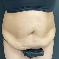 Abdominoplasty Before & After Patient #1070