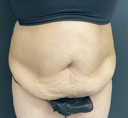 Abdominoplasty Before & After Patient #1070